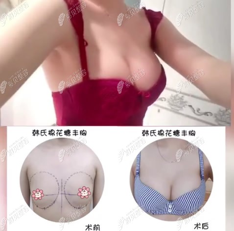 上海韩啸整形医院棉花糖假体丰胸300cc术后效果