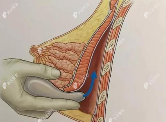 乳房下皱襞切口位置在哪里