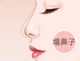 做bsk生态肋软骨隆鼻花3万多,做完没有软骨变形等副作用出现