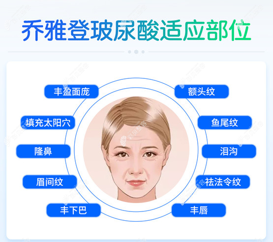 去法令纹应打哪种玻尿酸,打过瑞蓝/乔雅登品牌的我来告诉你