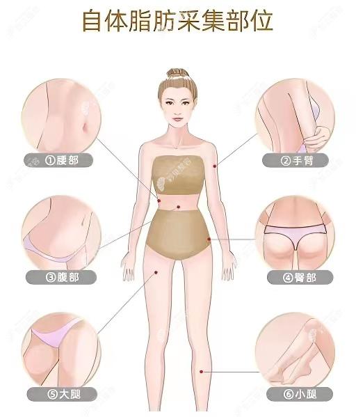 自体脂肪填充采集的脂肪部位