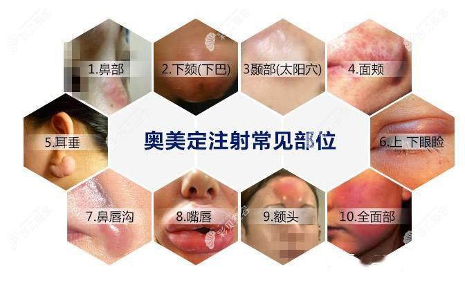 广州奥美定取出医院哪家好