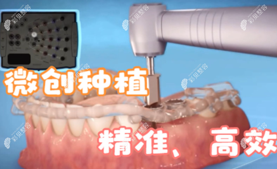 数字化导板种植牙和传统种植牙哪个好