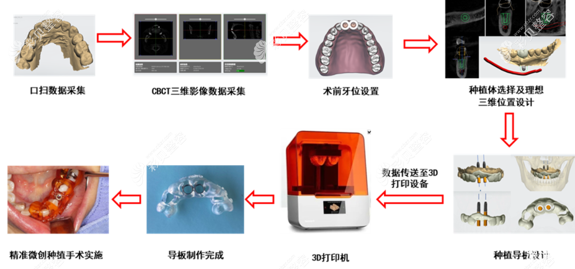 数字化导板种植牙手术过程和步骤