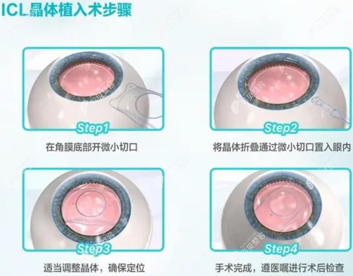 icl晶体植入术优缺点 彩贝网 icl晶体植入术优缺点 彩贝网